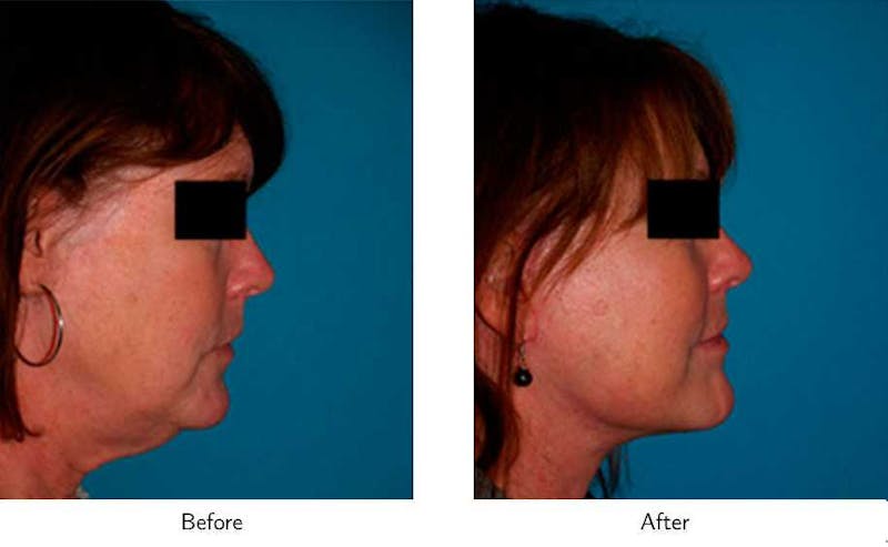 Facelift Before & After Gallery - Patient 64081060 - Image 1