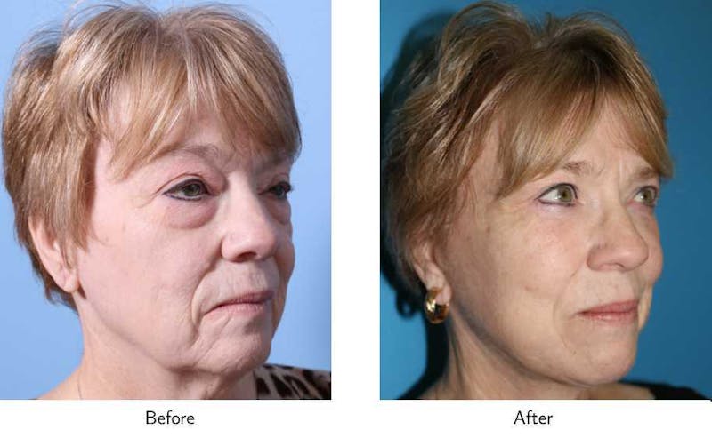 Facelift Before & After Gallery - Patient 64081061 - Image 1