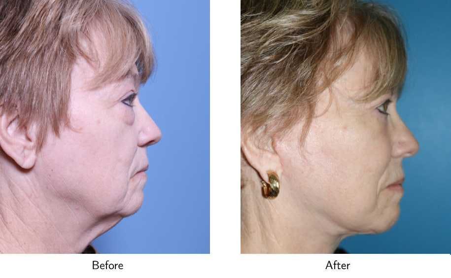 Facelift Before & After Gallery - Patient 64081061 - Image 2
