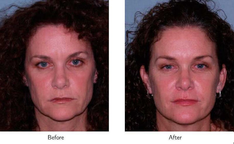 Facelift Before & After Gallery - Patient 64081062 - Image 1