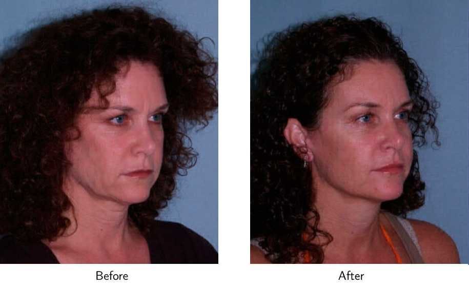 Facelift Before & After Gallery - Patient 64081062 - Image 2
