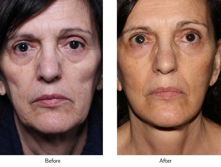 Facelift Before & After Gallery - Patient 64081063 - Image 2