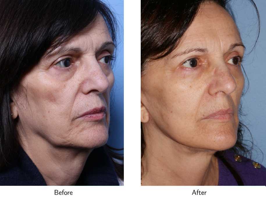 Patient 64081063 Facelift Before & After Photos Gold Coast Plastic