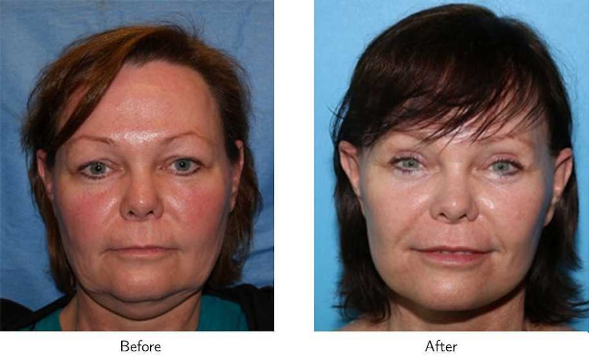 Facelift Before & After Gallery - Patient 64081064 - Image 2
