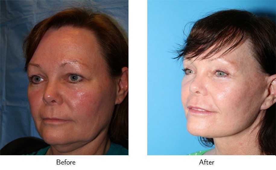 Facelift Before & After Gallery - Patient 64081064 - Image 2