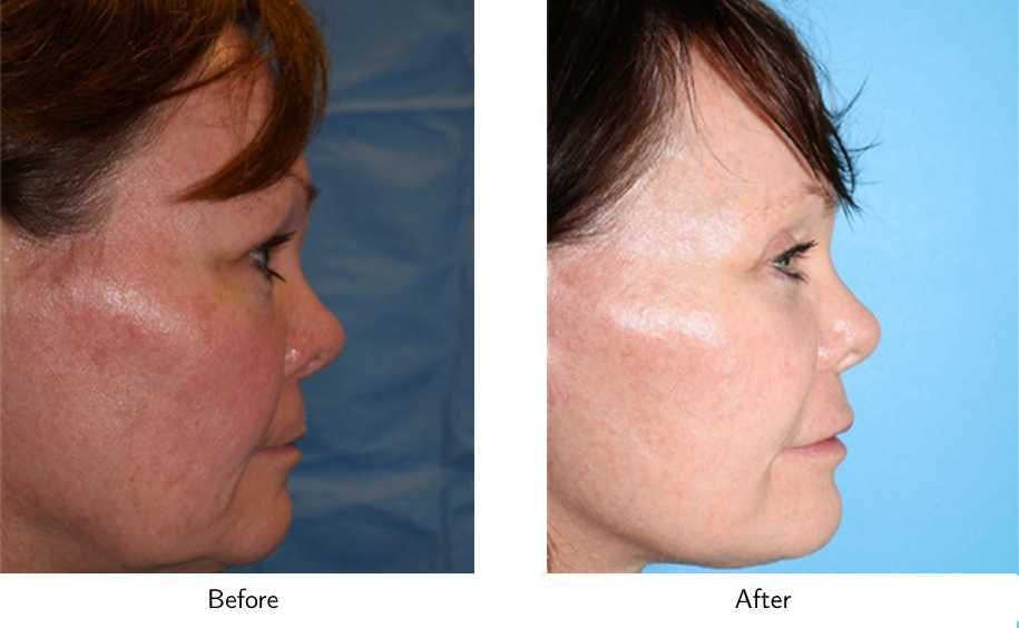 Facelift Before & After Gallery - Patient 64081064 - Image 3