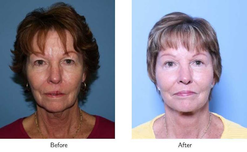 Facelift Before & After Gallery - Patient 64081065 - Image 1