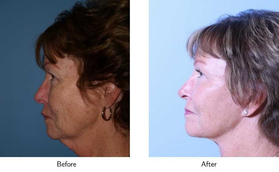 Facelift Before & After Gallery - Patient 64081065 - Image 3