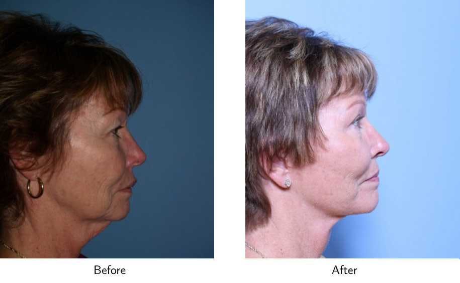 Facelift Before & After Gallery - Patient 64081065 - Image 3