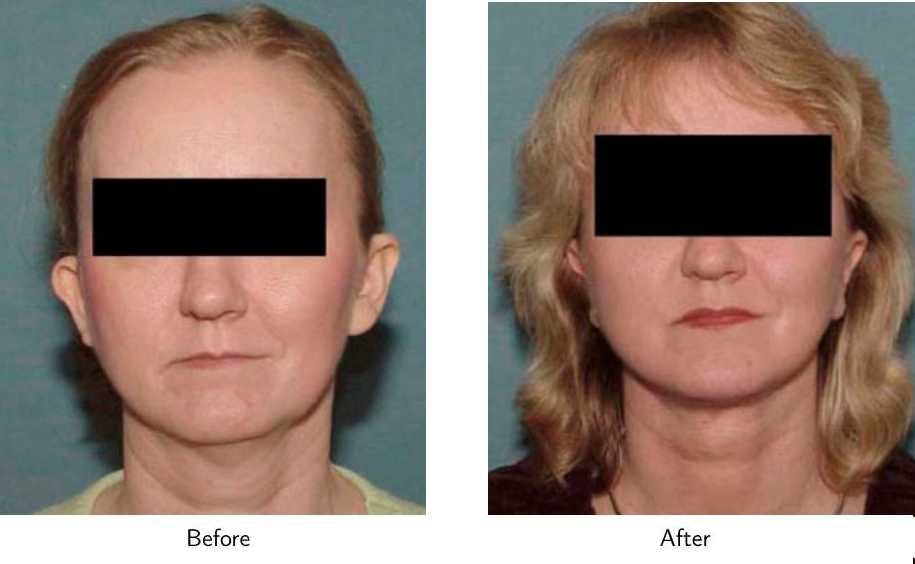 Facelift Before & After Gallery - Patient 64081066 - Image 2