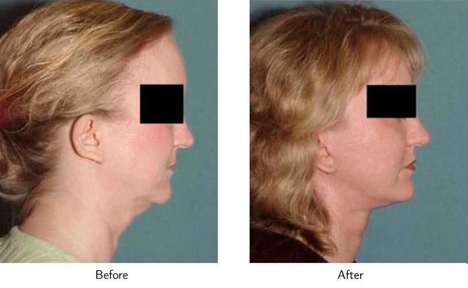 Facelift Before & After Gallery - Patient 64081066 - Image 3