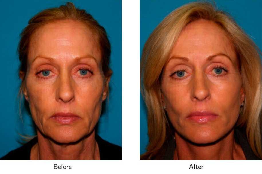 Facelift Before & After Gallery - Patient 64081067 - Image 3