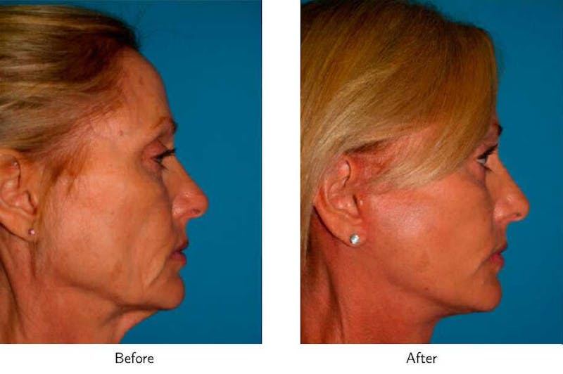 Facelift Before & After Gallery - Patient 64081067 - Image 1