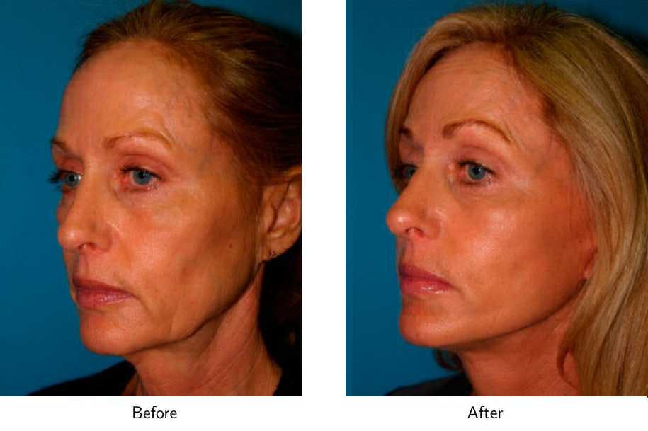 Facelift Before & After Gallery - Patient 64081067 - Image 5