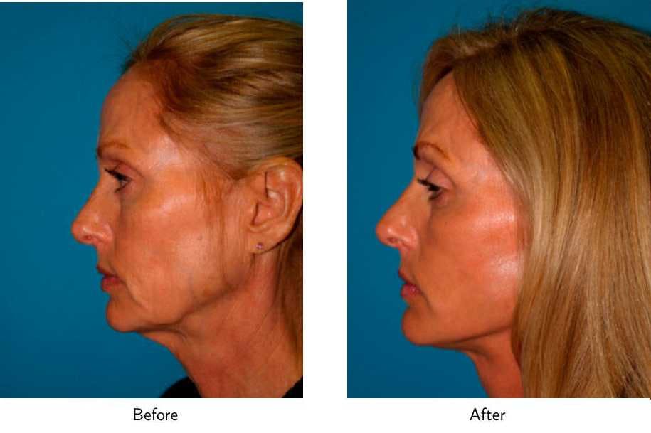 Facelift Before & After Gallery - Patient 64081067 - Image 3