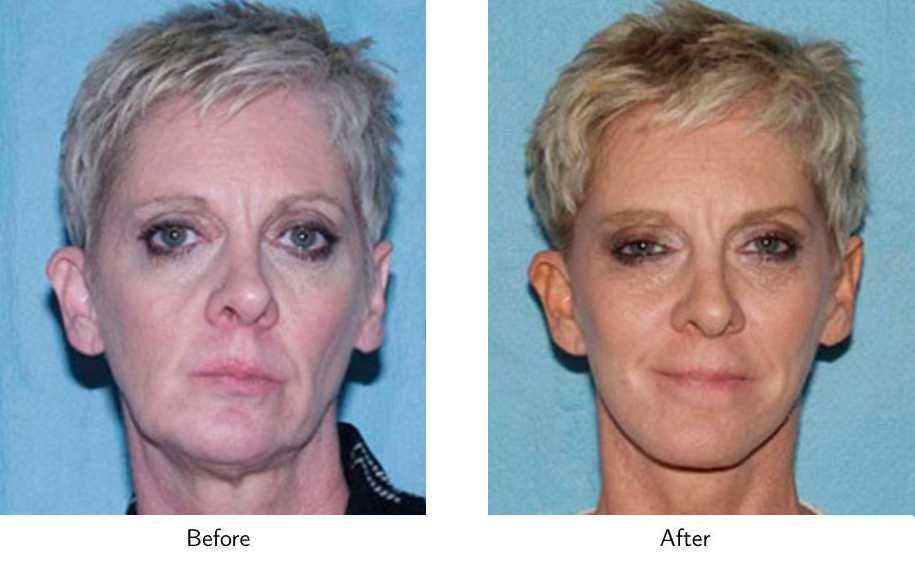 Facelift Before & After Gallery - Patient 64081068 - Image 1