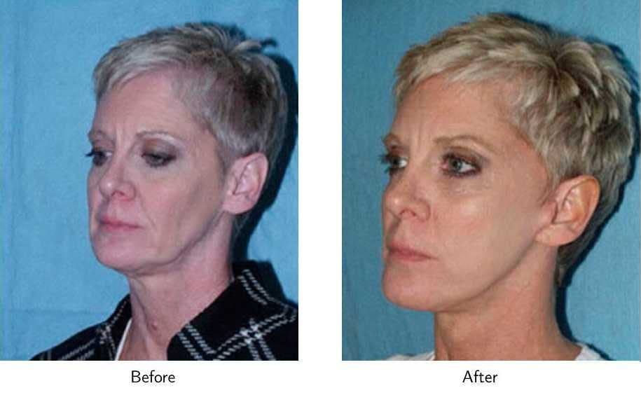 Facelift Before & After Gallery - Patient 64081068 - Image 3