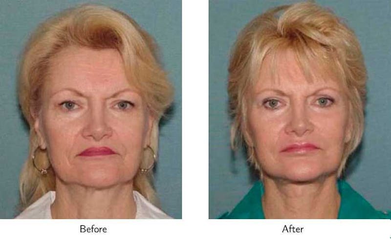 Facelift Before & After Gallery - Patient 64081069 - Image 1