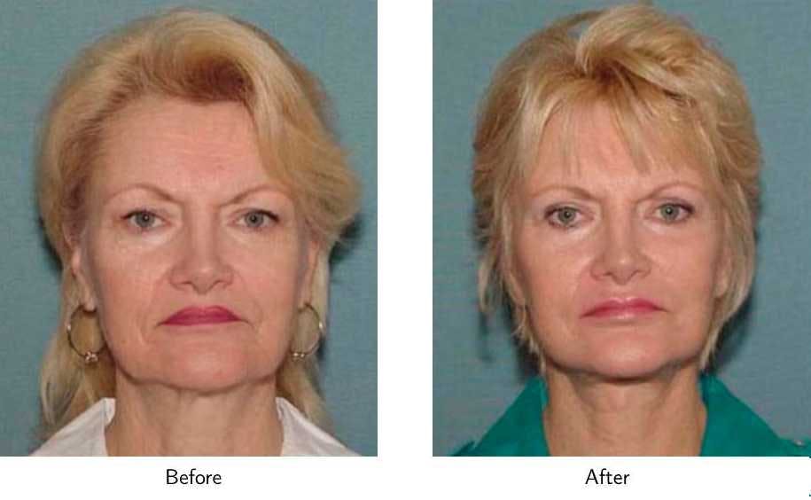 Facelift Before & After Gallery - Patient 64081069 - Image 2