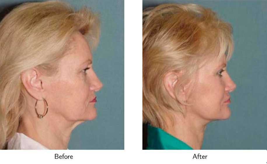 Facelift Before & After Gallery - Patient 64081069 - Image 2