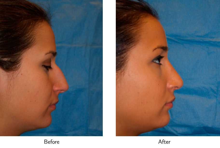 Rhinoplasty Before & After Gallery - Patient 64081076 - Image 2