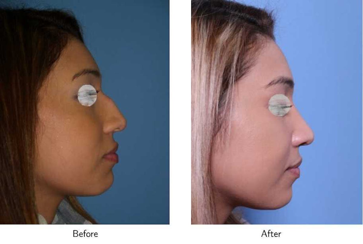 Rhinoplasty Before & After Gallery - Patient 64081079 - Image 1