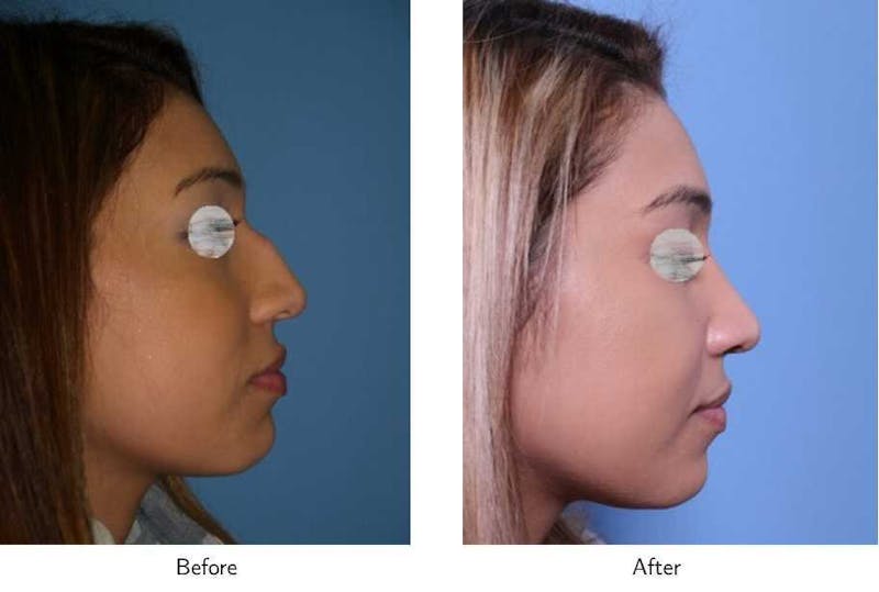 Rhinoplasty Before & After Gallery - Patient 64081079 - Image 1