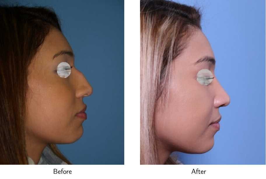 Rhinoplasty Before & After Gallery - Patient 64081079 - Image 1