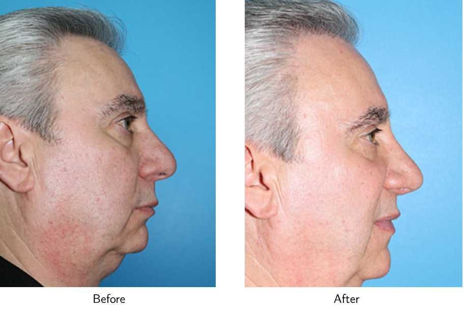 Rhinoplasty Before & After Gallery - Patient 64081085 - Image 2
