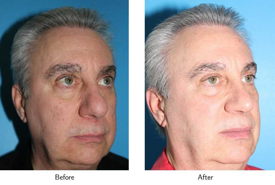 Rhinoplasty Before & After Gallery - Patient 64081085 - Image 3