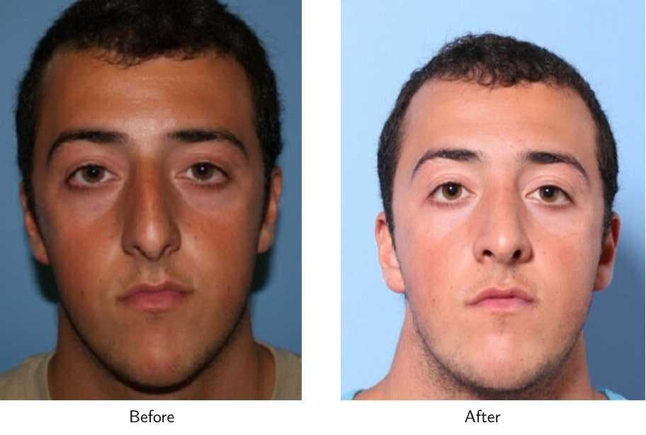 Rhinoplasty Before & After Gallery - Patient 64081086 - Image 1