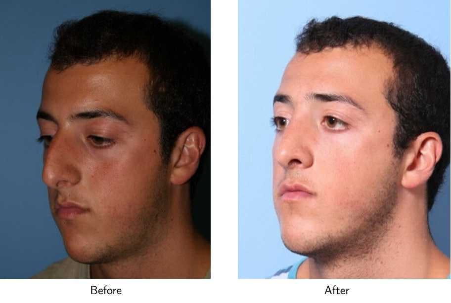 Rhinoplasty Before & After Gallery - Patient 64081086 - Image 4
