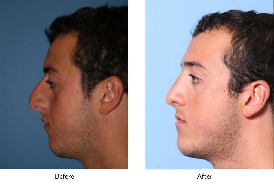 Rhinoplasty Before & After Gallery - Patient 64081086 - Image 3
