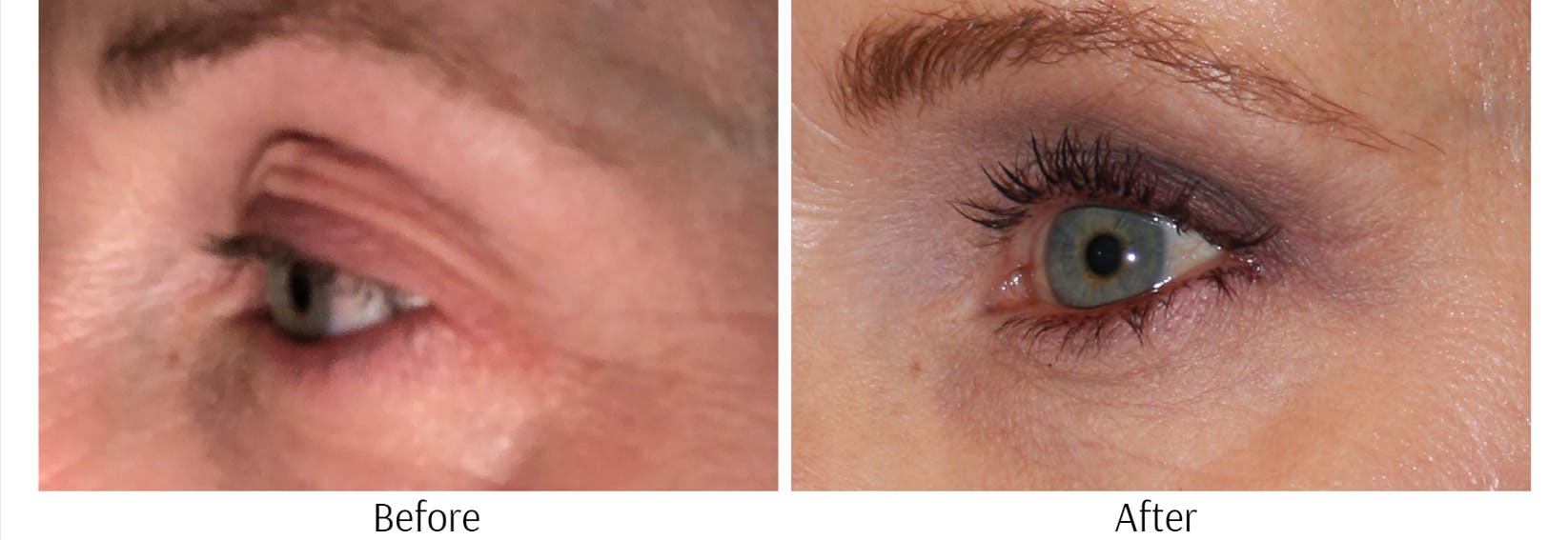 Blepharoplasty Before & After Gallery - Patient 64081088 - Image 2