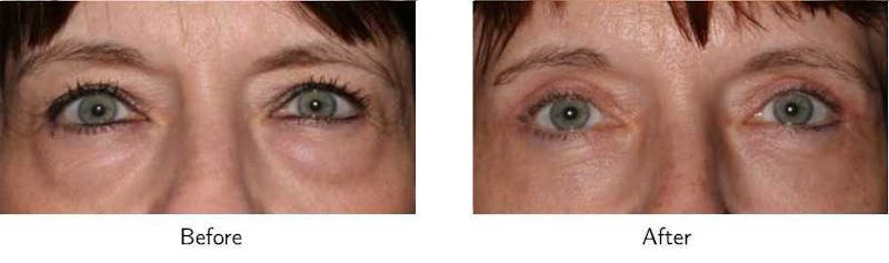 Blepharoplasty Before & After Gallery - Patient 64081091 - Image 1