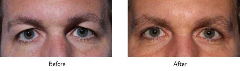 Blepharoplasty Before & After Gallery - Patient 64081093 - Image 1