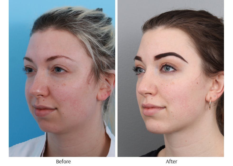 Chin Augmentation Before & After Gallery - Patient 64081105 - Image 4