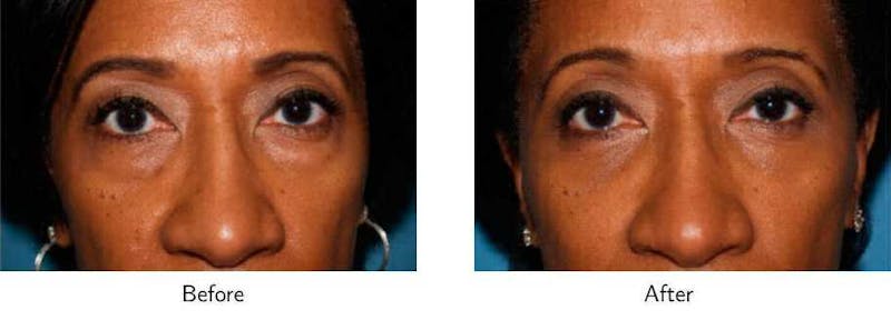 Blepharoplasty Before & After Gallery - Patient 64081099 - Image 1