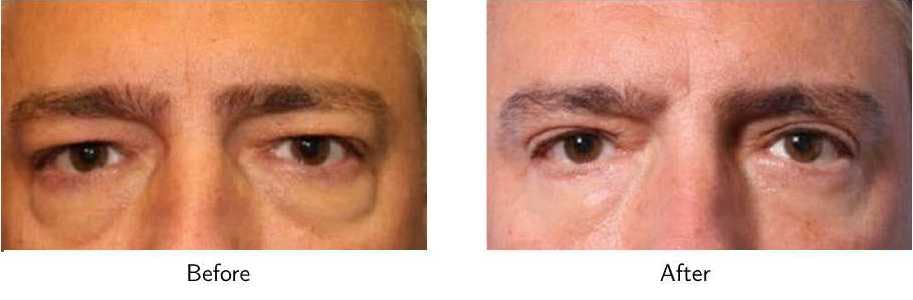 Blepharoplasty Before & After Gallery - Patient 64081100 - Image 1