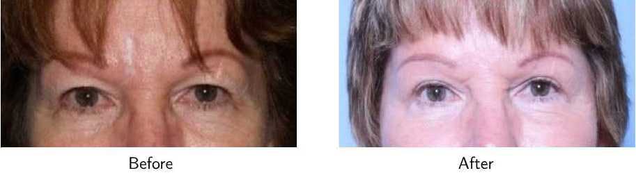 Blepharoplasty Before & After Gallery - Patient 64081101 - Image 1