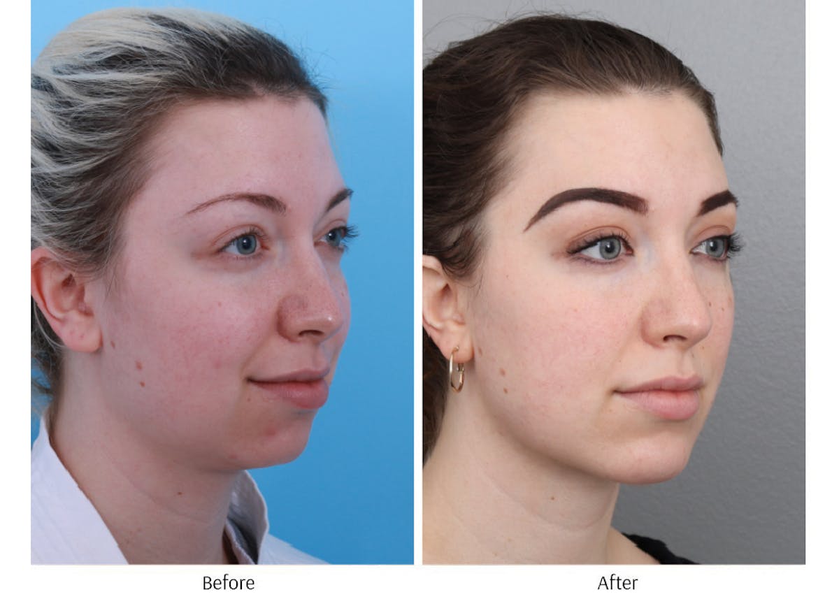 Chin Augmentation Before & After Gallery - Patient 64081105 - Image 1