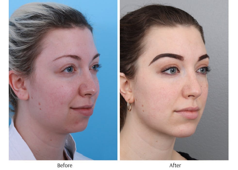 Chin Augmentation Before & After Gallery - Patient 64081105 - Image 1