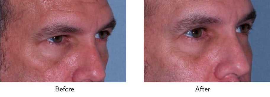 Blepharoplasty Before & After Gallery - Patient 64081103 - Image 2