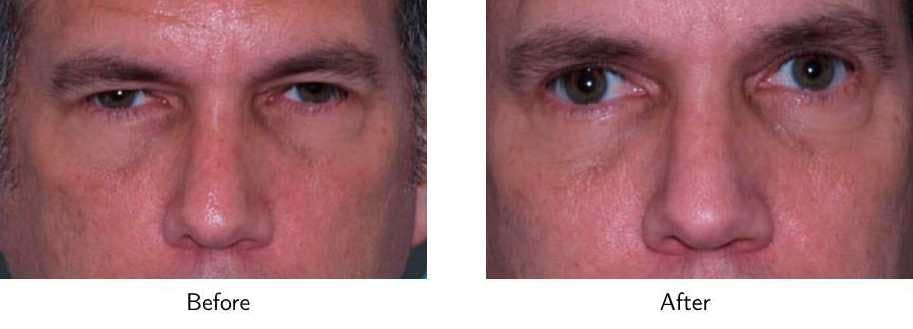 Blepharoplasty Before & After Gallery - Patient 64081103 - Image 1