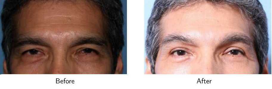 Blepharoplasty Before & After Gallery - Patient 64081104 - Image 1