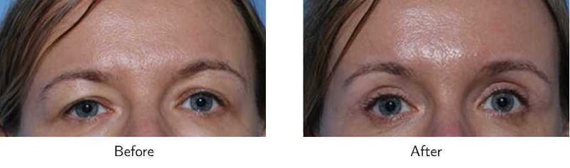 Blepharoplasty Before & After Gallery - Patient 64081106 - Image 1