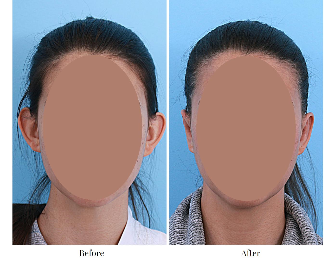 Ear Pinning (Otoplasty) Before & After Gallery - Patient 64081108 - Image 1