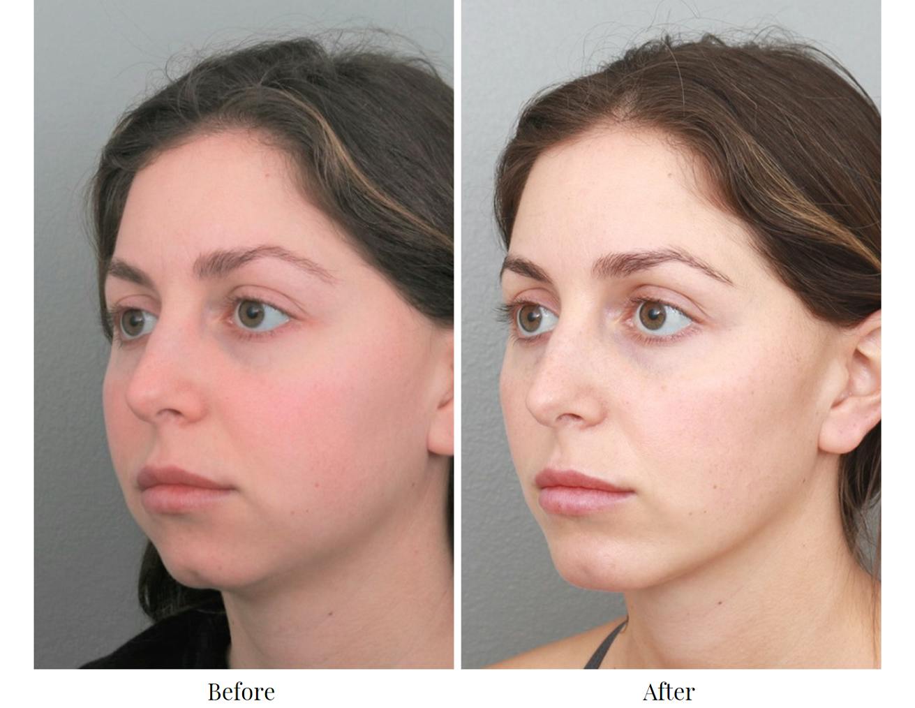 Chin Augmentation Before & After Gallery - Patient 64081117 - Image 2