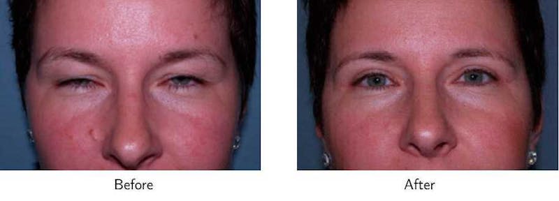 Blepharoplasty Before & After Gallery - Patient 64081109 - Image 1