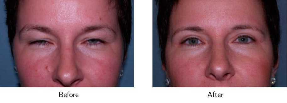 Blepharoplasty Before & After Gallery - Patient 64081109 - Image 1